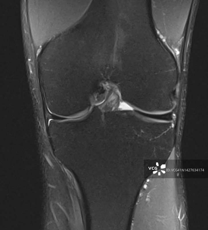 冠状PD FatSat MRI图像上的盘状外侧半月板图片素材