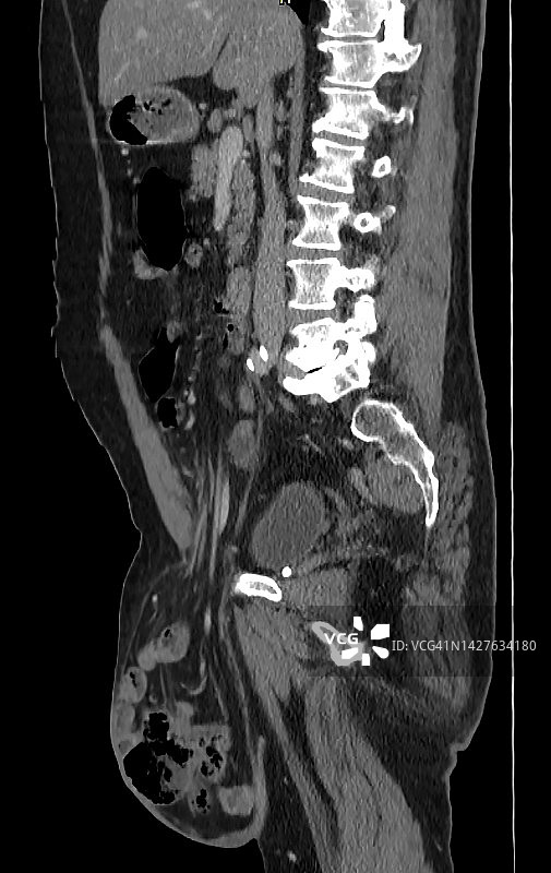 计算机断层扫描显示的腹股沟疝气图片素材