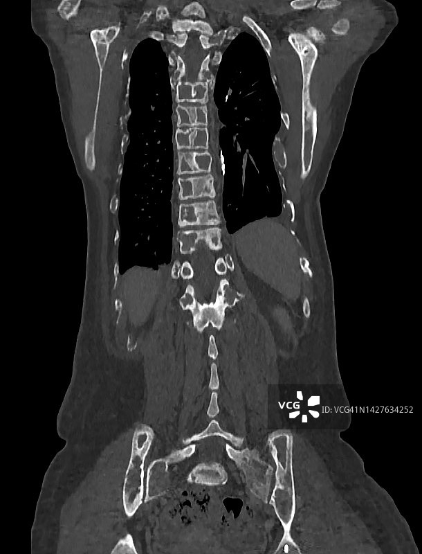 纤维结构不良和McCune-Albright综合征CT图图片素材
