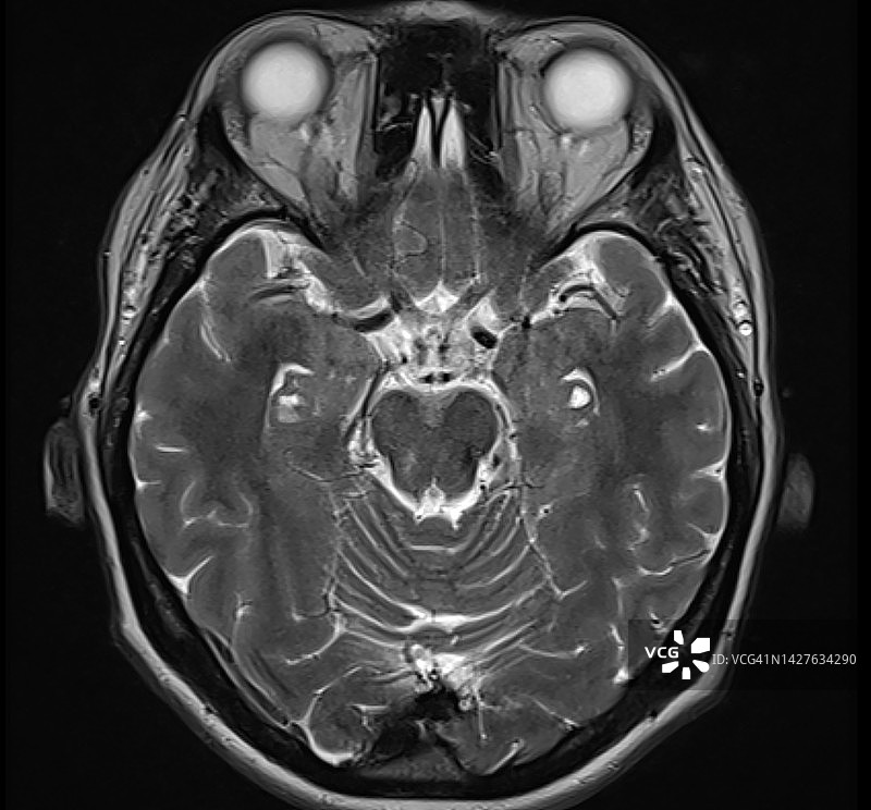 T2轴向MRI（磁共振成像）显示的颞海马沟残余囊肿图片素材