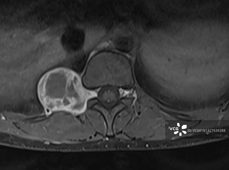 核磁共振成像显示的腰椎囊性神经鞘瘤轴位图图片素材