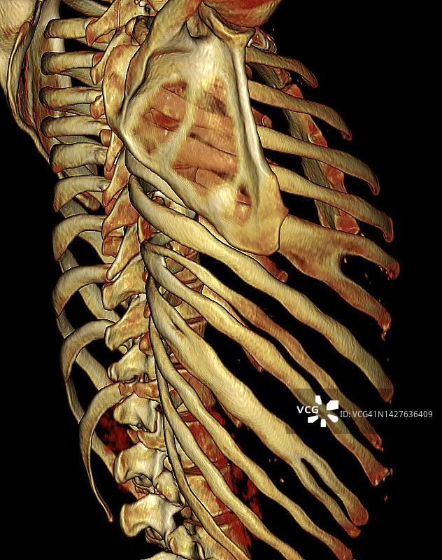 先天性肋骨融合3D图像CT图片素材