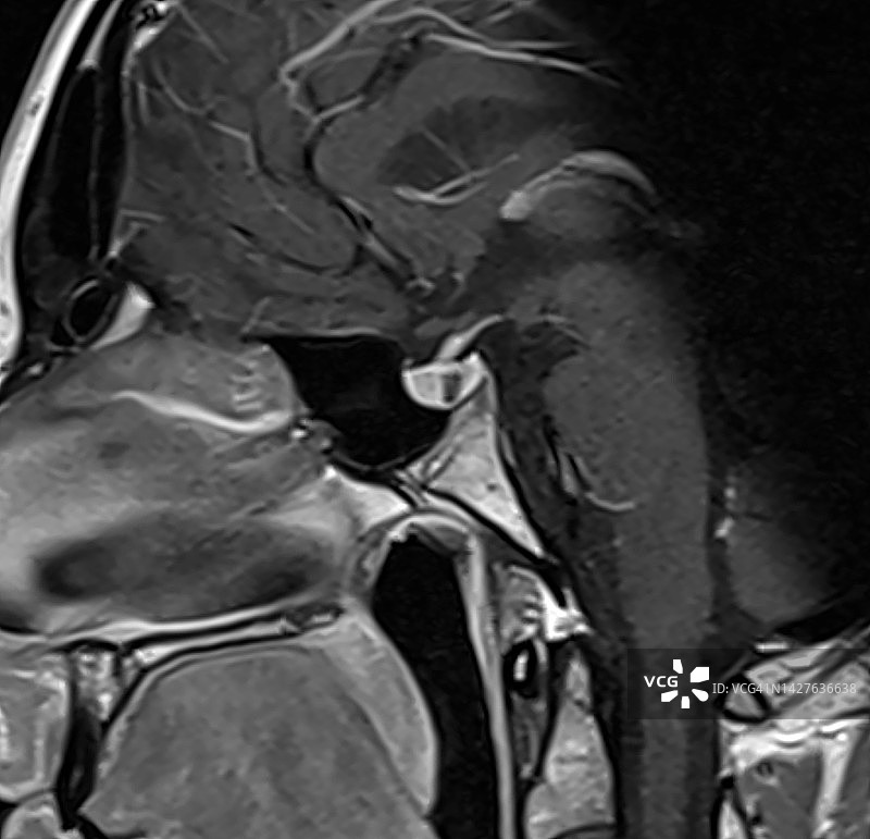 鞍旁囊肿，也称为正中囊肿，矢状位MRI T1加钆显影图像图片素材