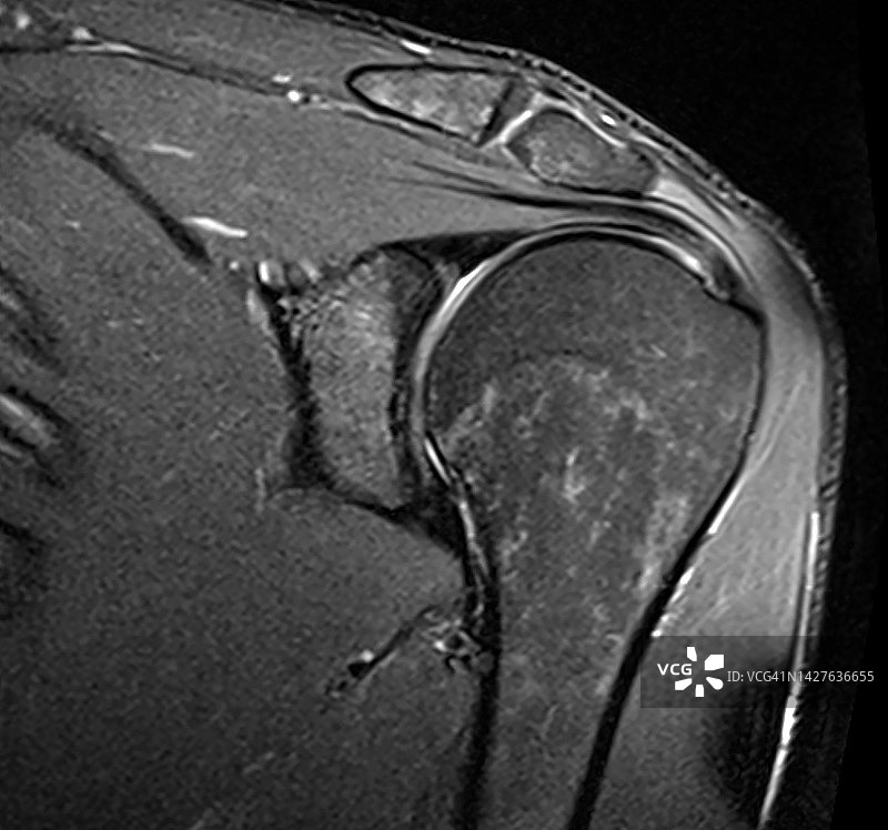 肩部核磁共振图像：肱骨头与冈上肌腱图片素材