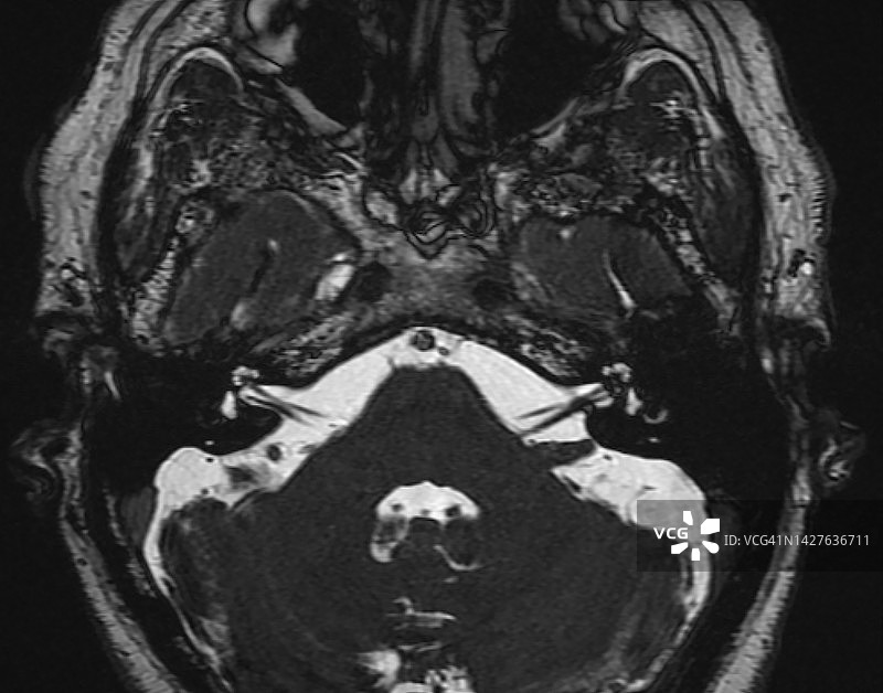 内耳和内听道解剖结构，内耳核磁共振成像图片素材