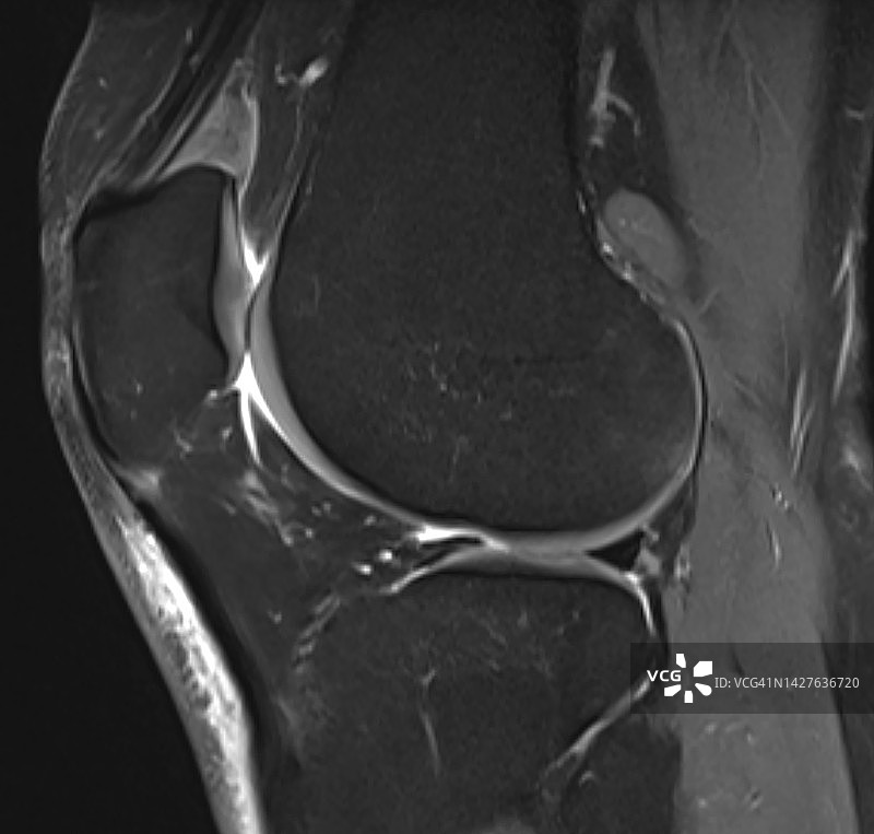 髌上脂肪垫撞击综合征，矢状T2脂肪饱和MRI图像，股四头肌脂肪垫撞击综合征图片素材