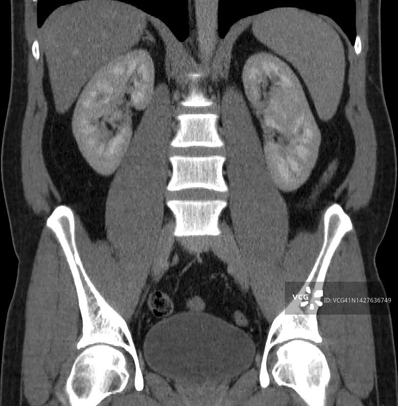 左肾Bertin柱肥大，冠状CT重建图片素材