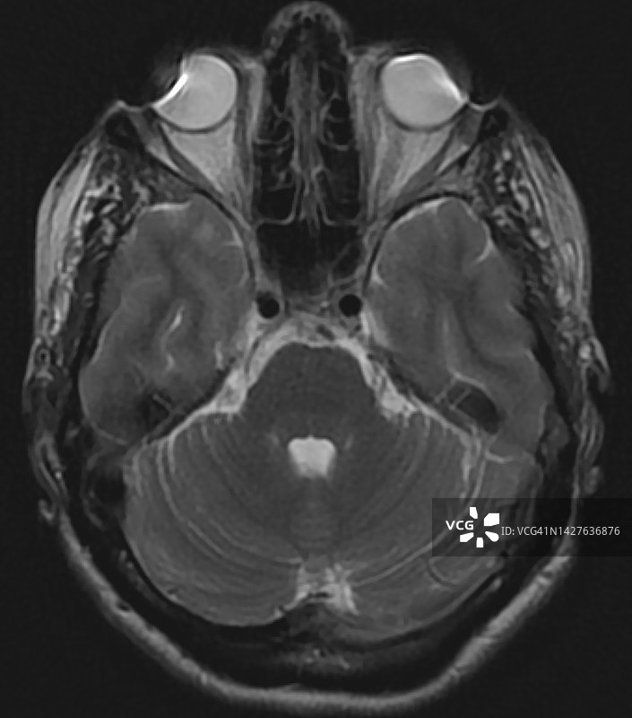化妆品在头部磁共振成像中引起的伪影图片素材