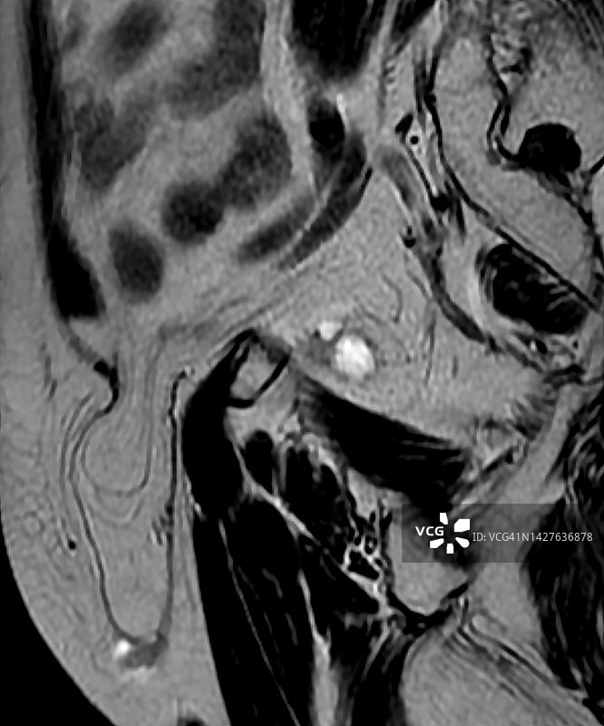 腹股沟疝的矢状T2 MRI影像诊断图片素材