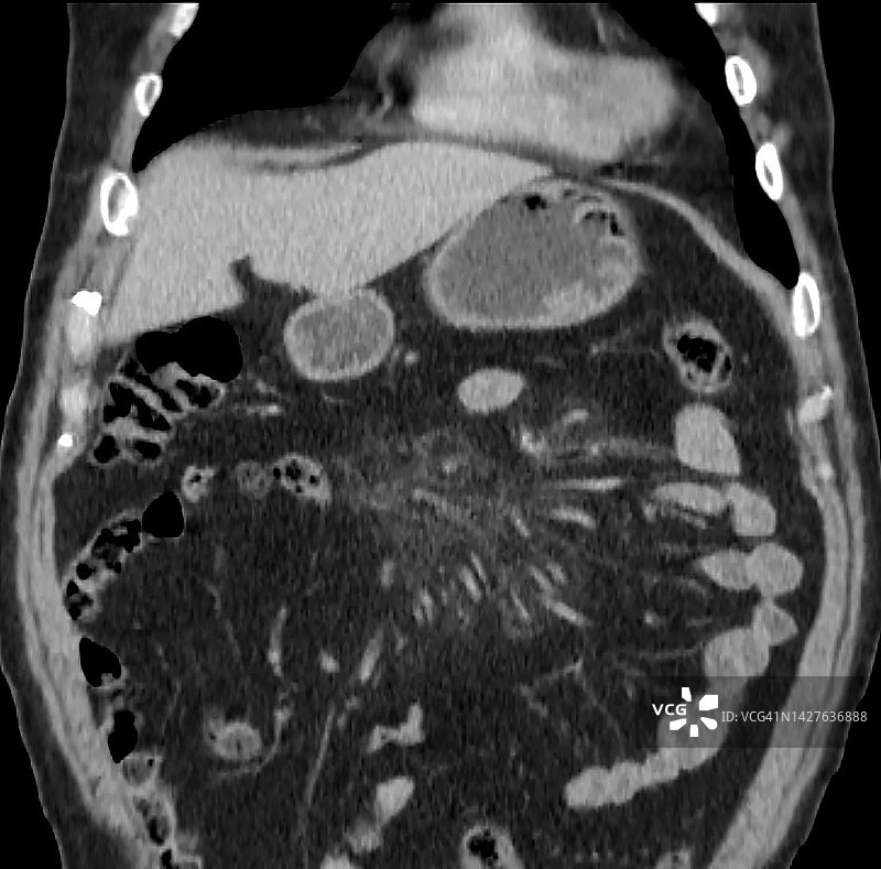 硬化性肠系膜炎（脂膜炎）的CT表现，冠状位图片素材