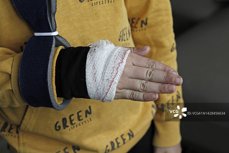 男孩手臂骨折打着石膏的特写图片素材