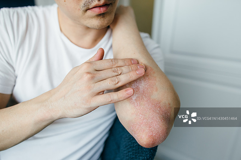 男人使用药膏治疗湿疹、牛皮癣等皮肤病图片素材