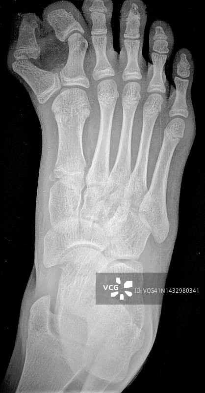 多余的脚趾，X光片图片素材