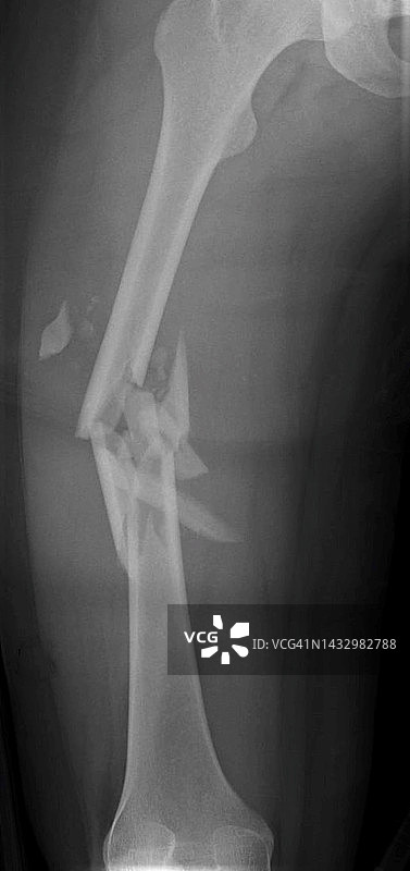 股骨骨折X光片图片素材