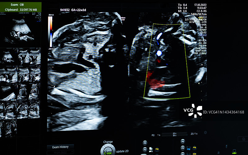 怀孕22周胎儿的超声波扫描图图片素材