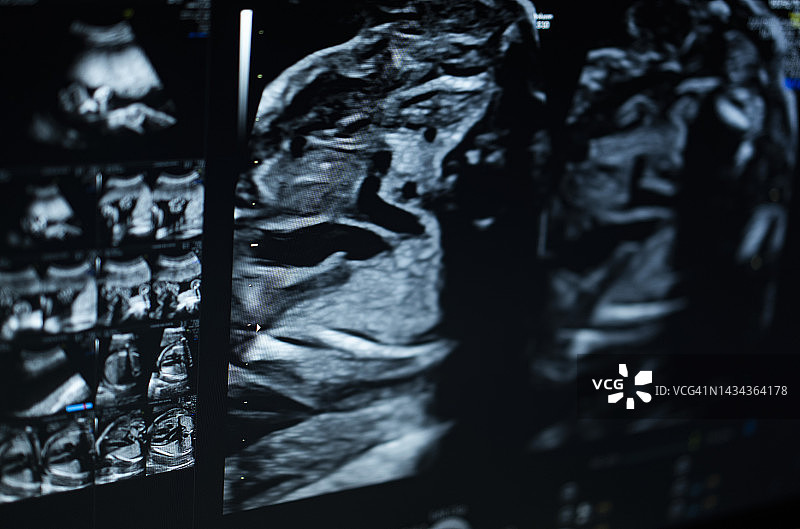 怀孕22周胎儿的超声波扫描图图片素材