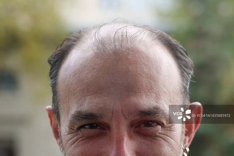 脱发问题图片素材