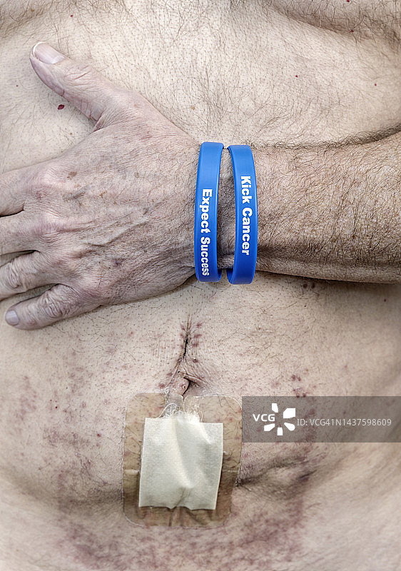 癌症患者：结肠手术疤痕周围疼痛的皮肤图片素材