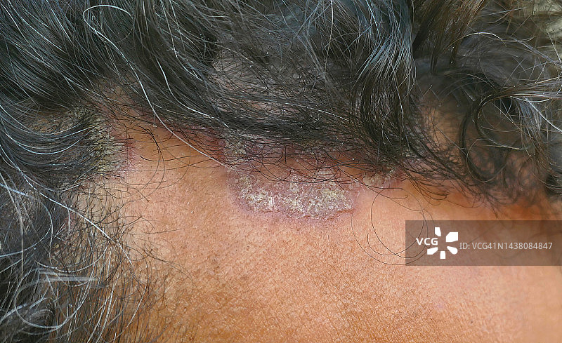 脂溢性皮炎图片素材