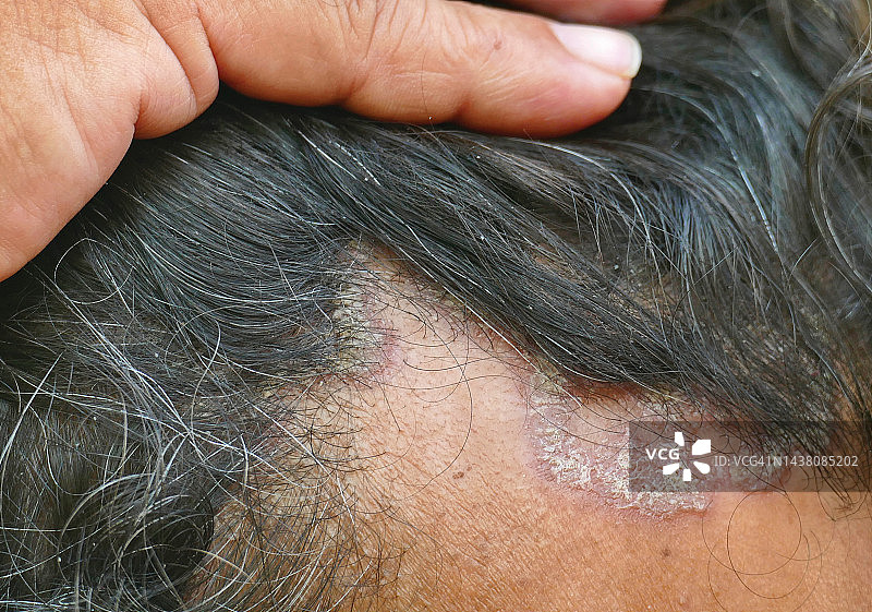 脂溢性皮炎图片素材