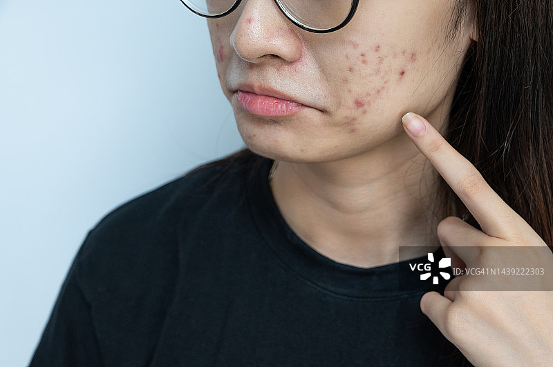 女子指着脸颊上的痘痘图片素材