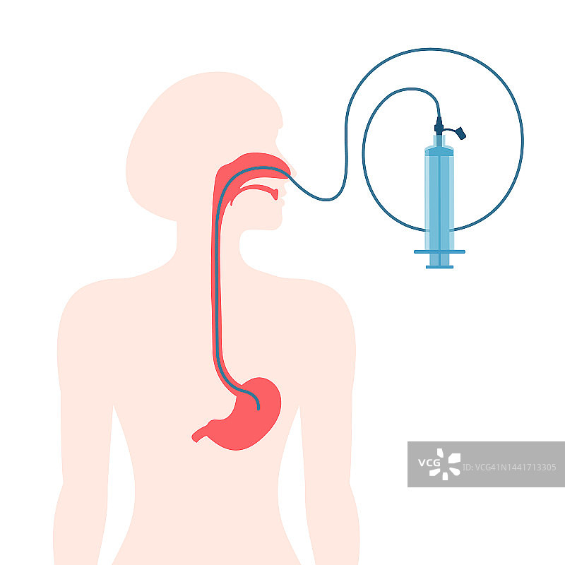 鼻饲管示意图图片素材