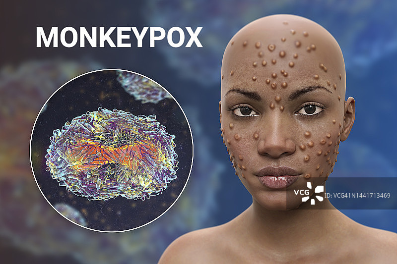猴痘感染插图图片素材