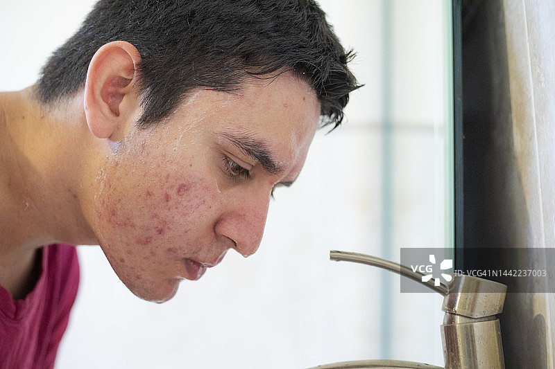 有痤疮的年轻男人图片素材