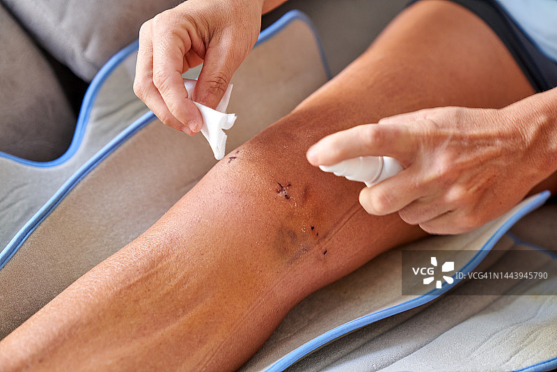 膝盖手术后在家治疗腿部的女人图片素材