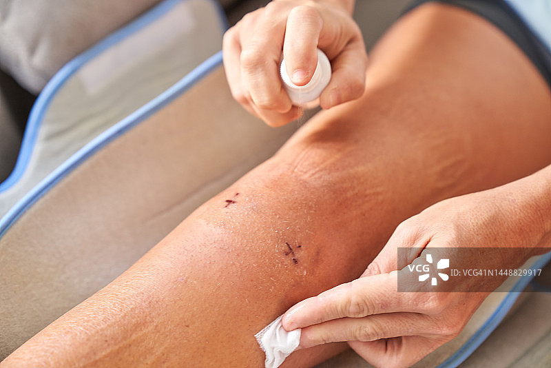 膝关节腹腔镜手术后在家治疗腿部的女人图片素材