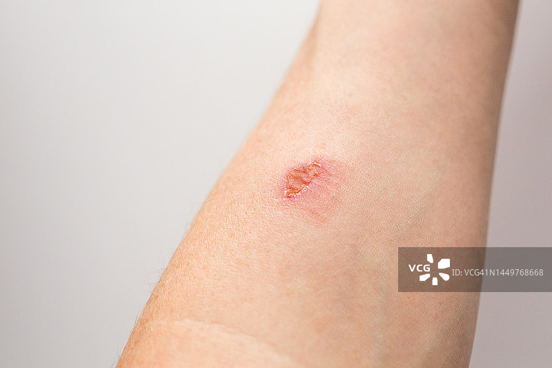 手臂皮肤烧伤发红图片素材