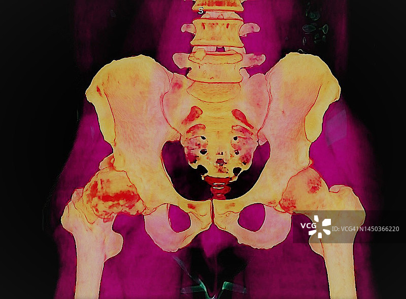 髋关节骨关节炎3D CT扫描图片素材