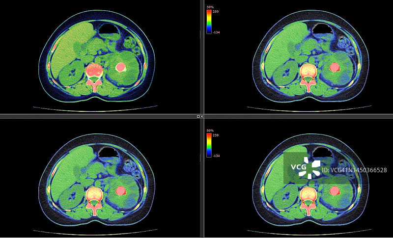 肾结石CT扫描图片素材