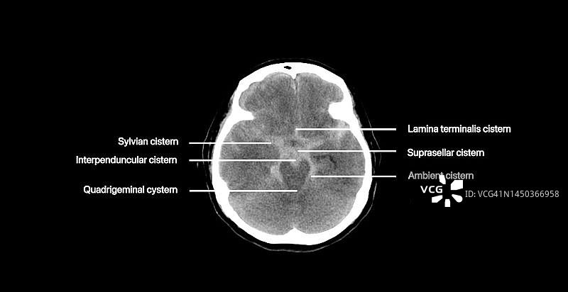 蛛网膜下腔出血CT扫描图片素材