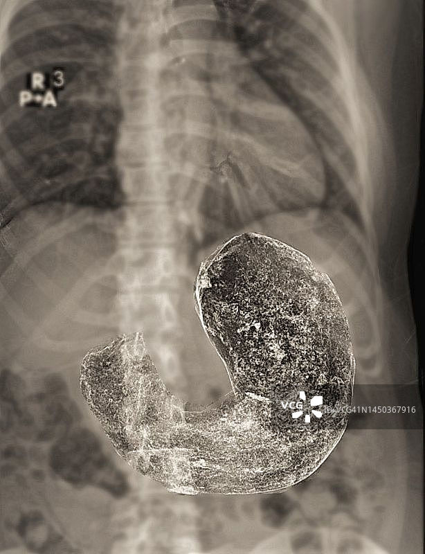 健康的胃部钡餐X光片图片素材