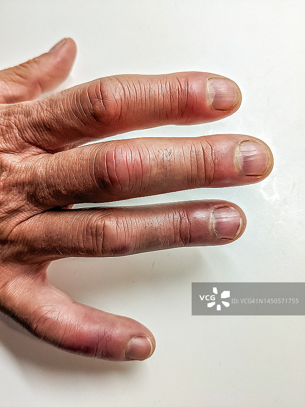 莱姆病引起的关节炎手指特写图片素材