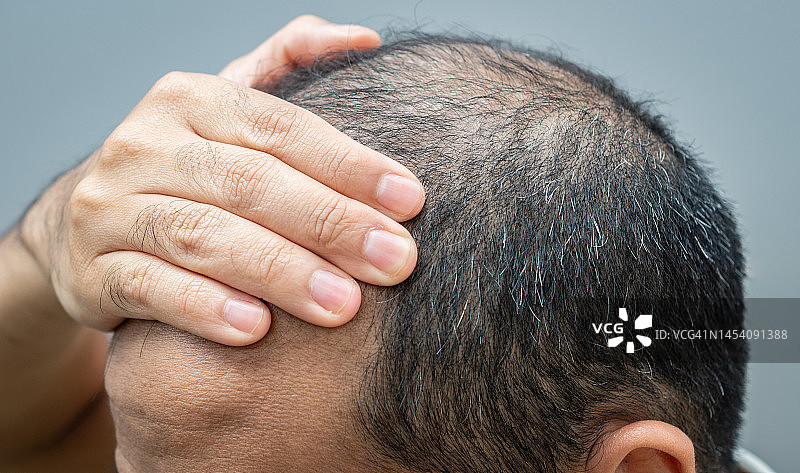 亚洲男人摸着额头掩饰秃顶特写，脱发和白发是男性衰老的标志图片素材