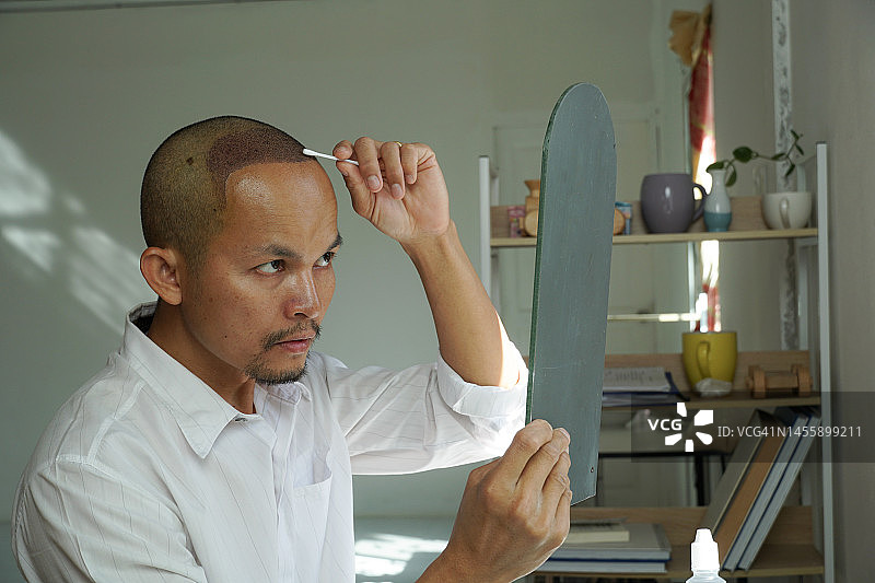 亚洲男人植发：术后清理头皮图片素材