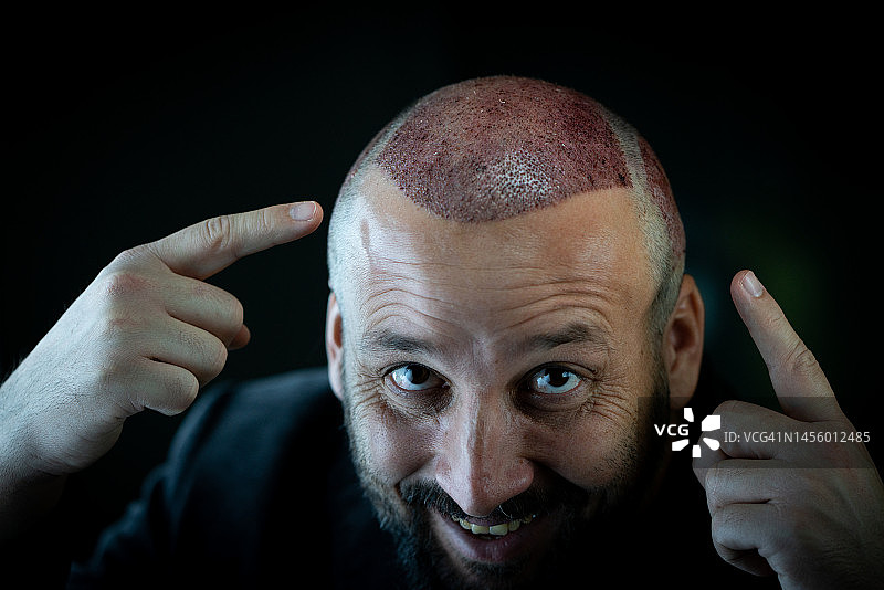 植发患者在黑色背景下的肖像图片素材