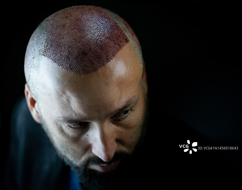植发患者在黑色背景下的肖像图片素材