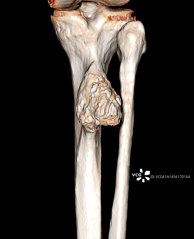 计算机断层扫描显示的胫骨表面骨软骨瘤或外生骨疣3D重建图片素材