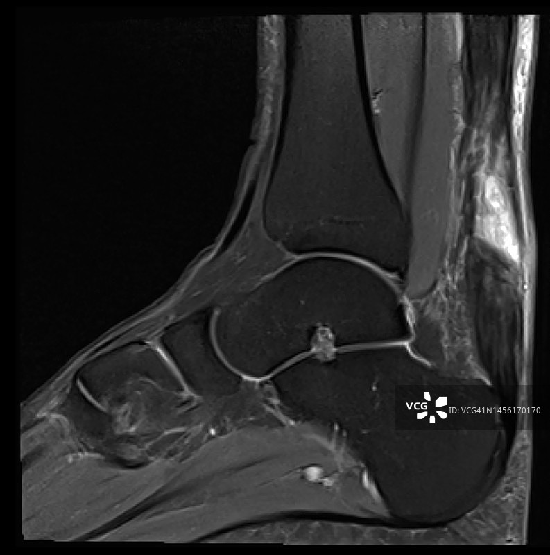 MRI矢状位显示的跟腱病和跟腱断裂图片素材