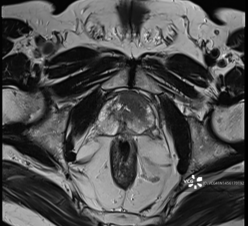 磁共振成像在前列腺癌中的作用：核磁共振左侧前列腺肿瘤图片素材
