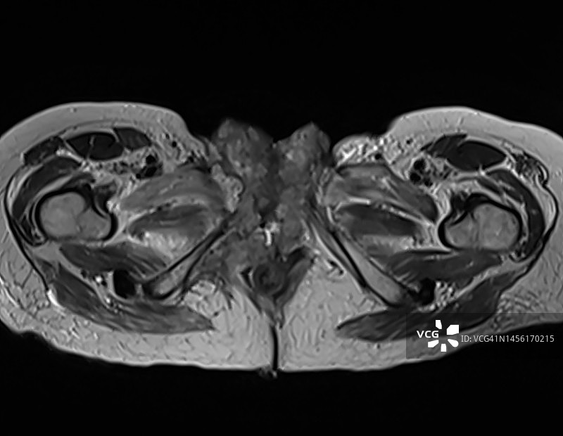 侵袭性会阴肿块的MRI特征，轴向T2视图图片素材