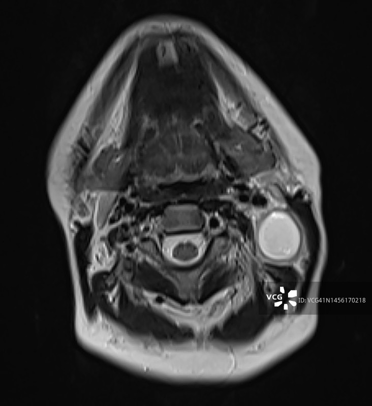 鳃裂囊肿的核磁共振表现，轴位T2视图图片素材