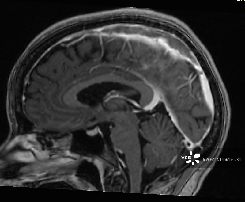 上矢状窦血栓（SSST）MRI矢状位图图片素材