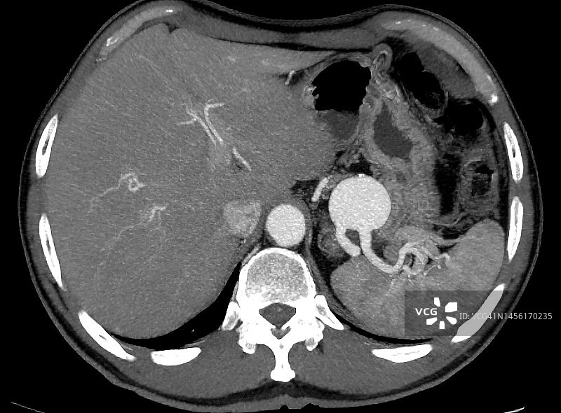 CT图像：脾动脉巨大动脉瘤图片素材