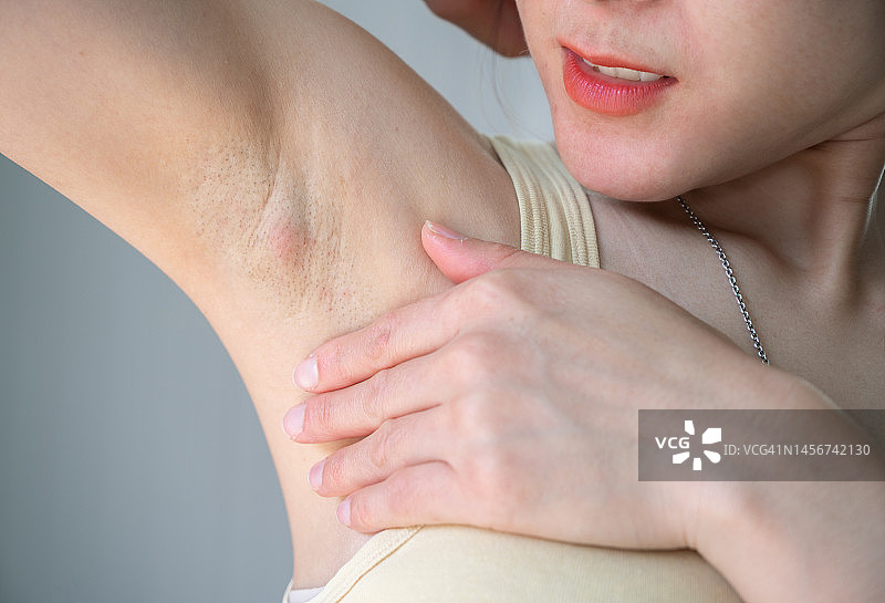 女人腋窝下腋窝淋巴结肿大的局部照片图片素材