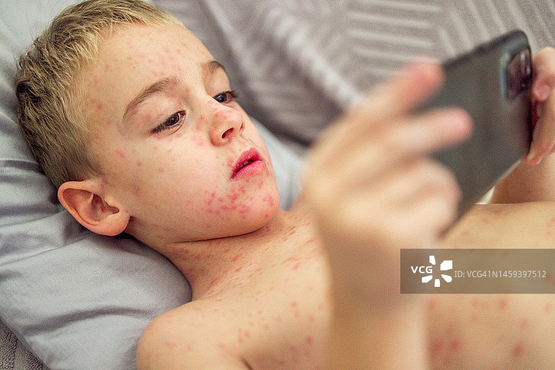 男孩躺在床上玩手机，皮肤上布满痘疹特写图片素材