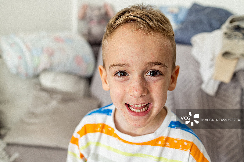 面带微笑，皮肤感染水痘的白人男孩肖像图片素材